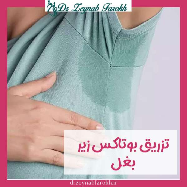 بوتاکس زیر بغل