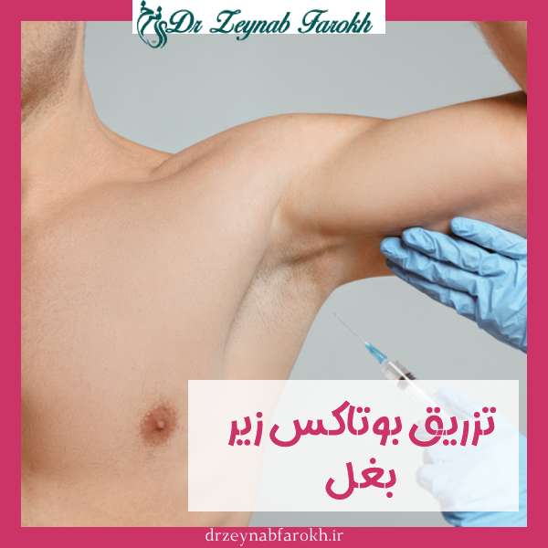 بوتاکس ضد تعریق (زیر بغل)