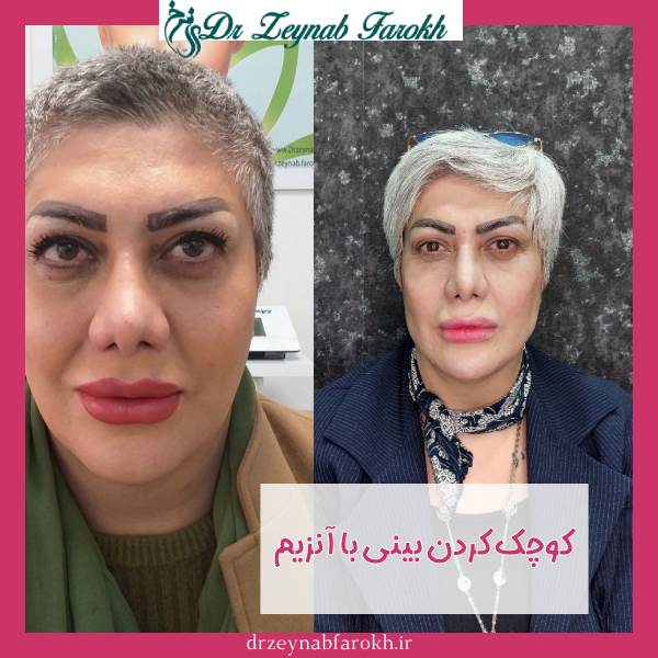 کوچک کردن بینی با آنزیم