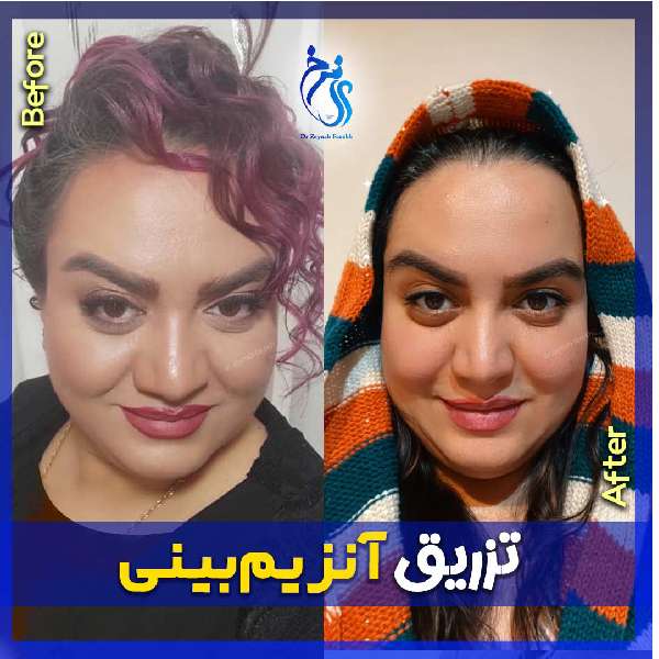 کوچک کردن بینی گوشتی