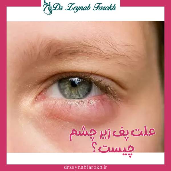 پف زیر چشم
