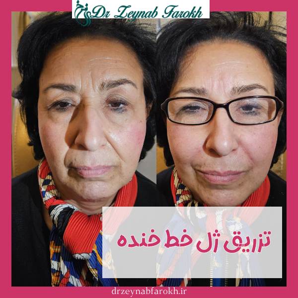 تزریق ژل خط خنده