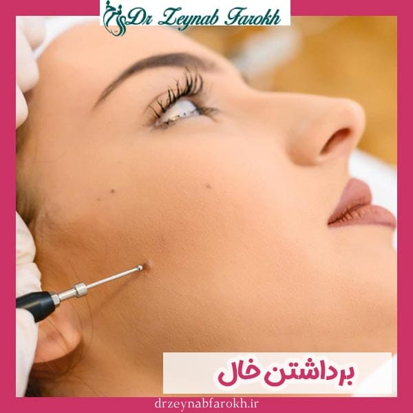 برداشتن خال