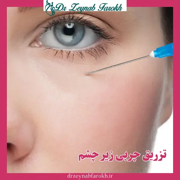 تزریق چربی زیر چشم _ دکتر زینب فرخ