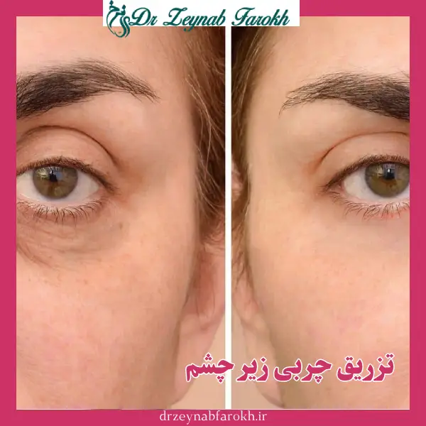 تزریق چربی زیر چشم _ دکتر زینب فرخ