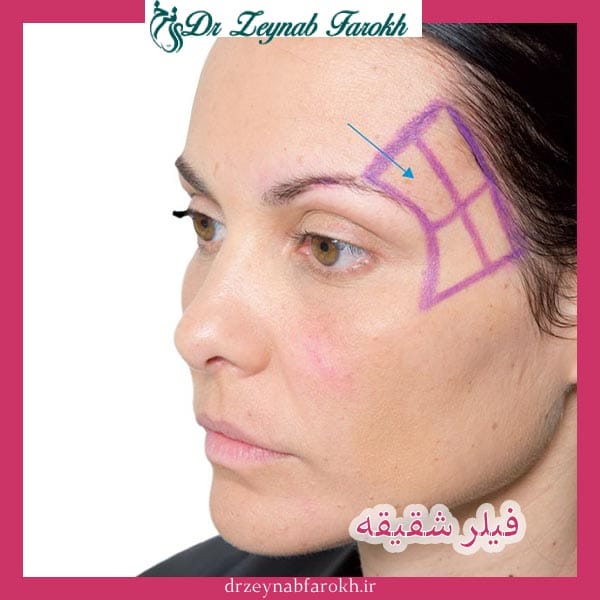 تزریق فیلر شقیقه _ دکتر زینب فرخ 