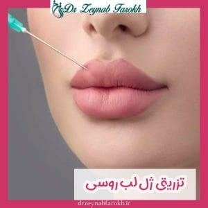 تزریق ژل لب روسی _ دکتر زینب فرخ