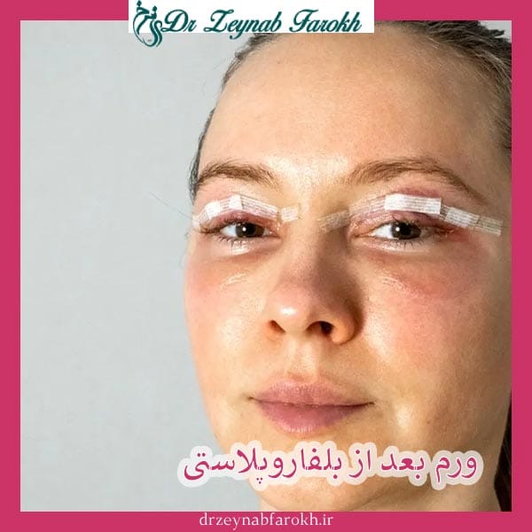 ورم بعد از بلفاروپلاستی _ دکتر مژده تواضع