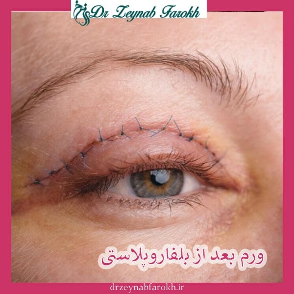 ورم بعد از بلفاروپلاستی _ دکتر مژده تواضع