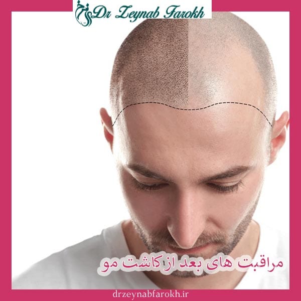 مراقبت های بعد ازکاشت مو _ دکتر زینب فرخ