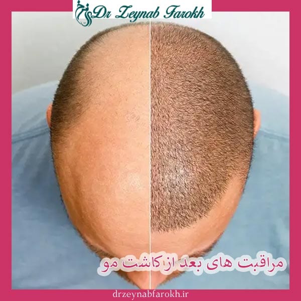 مراقبت های بعد ازکاشت مو _ دکتر زینب فرخ