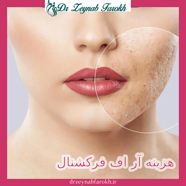 هزینه آر اف فرکشنال _ دکتر زینب فرخ