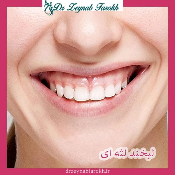 لبخند لثه ای _ دکتر زینب فرخ