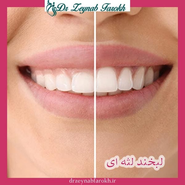 لبخند لثه ای _ دکتر زینب فرخ 