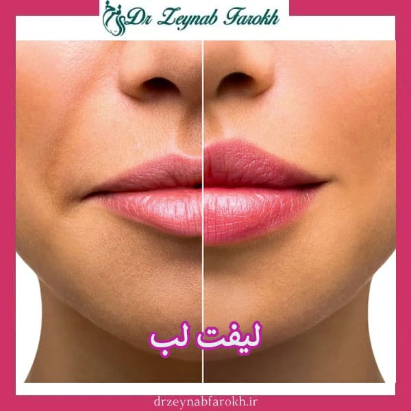 لیفت لب _ دکتر زینب فرخ 