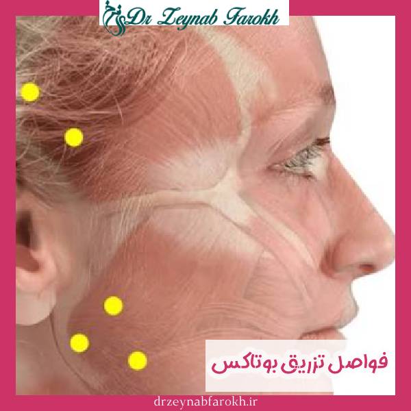 فواصل تزریق بوتاکس
