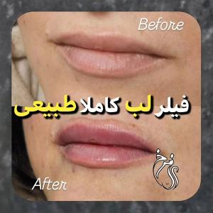gel-injection-in-Tehran-173