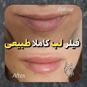 gel-injection-in-Tehran-174