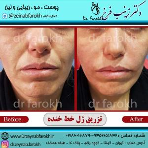 تزریق-ژل-خط-خنده-1