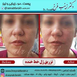 تزریق-ژل-خط-خنده-2