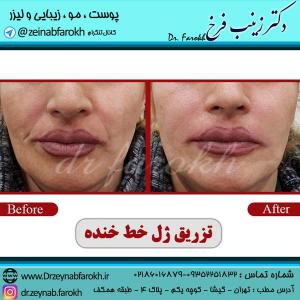 تزریق-ژل-خط-خنده-5