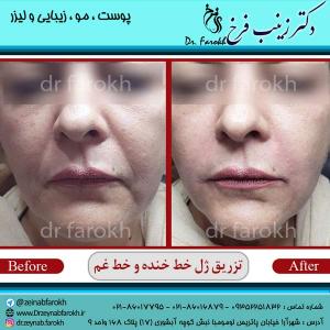 تزریق-ژل-خط-خنده-و-خط-غم