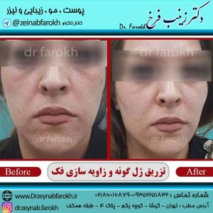 تزریق-ژل-گونه-و-زاویه-سازی-فک