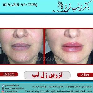 تزریق ژل لب
