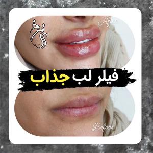 gel-injection-in-tehran-167