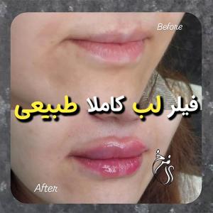 gel-injection-in-tehran-168