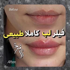 gel-injection-in-tehran-169
