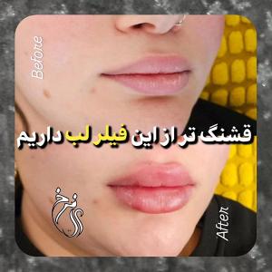 gel-injection-in-tehran-170