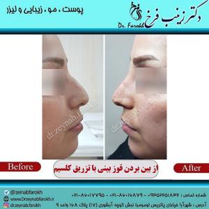 از-بین-بردن-قوز-بینی-با-کلسیم