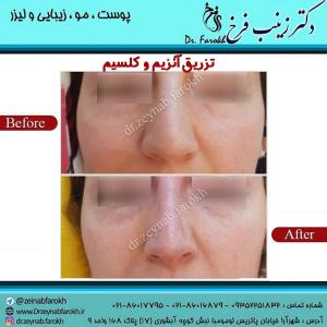 تزریق-آنزیم-و-کلسیم-به-بینی-2