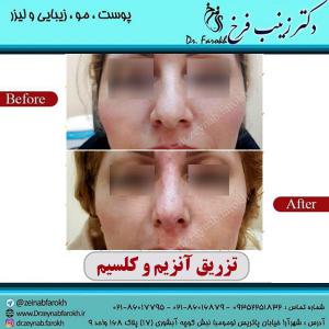 تزریق-آنزیم-و-کلسیم-به-بینی-4
