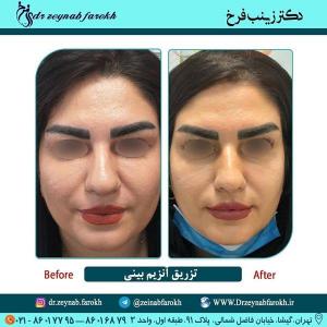 تزریق آنزیم بینی 251