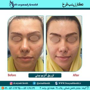 تزریق آنزیم بینی 40