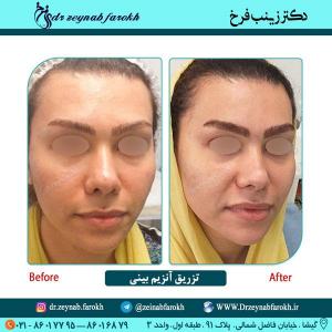 تزریق آنزیم بینی 41