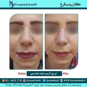 تزریق آنزیم و  لیفت تیغه بینی 5