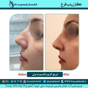 تزریق آنزیم و  لیفت تیغه بینی 6