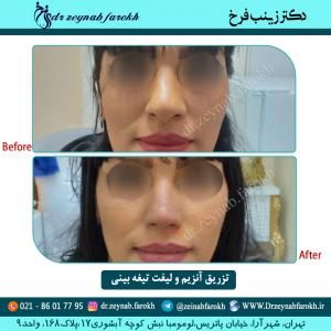 تزریق آنزیم و لیفت تیغه بینی 1