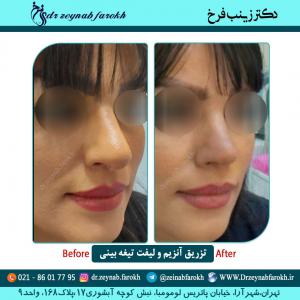 تزریق آنزیم و لیفت تیغه بینی 2