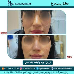 تزریق آنزیم و لیفت تیغه بینی 3