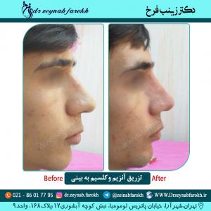 تزریق آنزیم و کلسیم به بینی