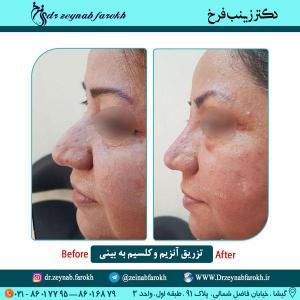تزریق آنزیم و کلسیم به بینی 1 (1)