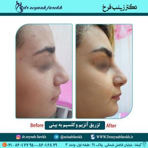 تزریق آنزیم و کلسیم به بینی 2