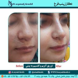 تزریق آنزیم و کلسیم به بینی 3