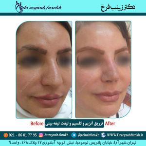 تزریق آنزیم و کلسیم و لیفت تیغه بینی 2