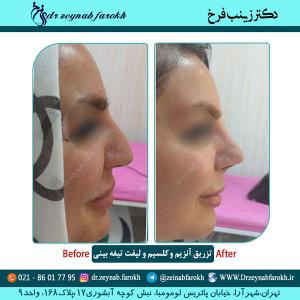 تزریق آنزیم و کلسیم و لیفت تیغه بینی 3