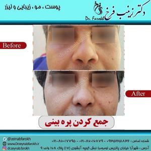 جمع-کردن-پره-بینی